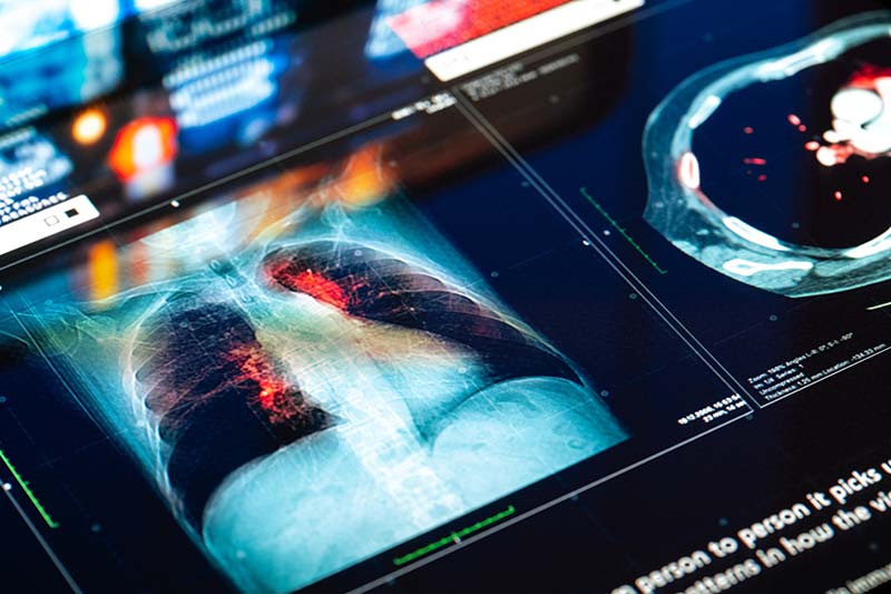 Digital medical imaging display showing chest scans with highlighted lung regions and data overlays, representing advanced radiology analysis, AI-assisted detection, and the need for accurate, reliable follow-up of diagnostic findings.