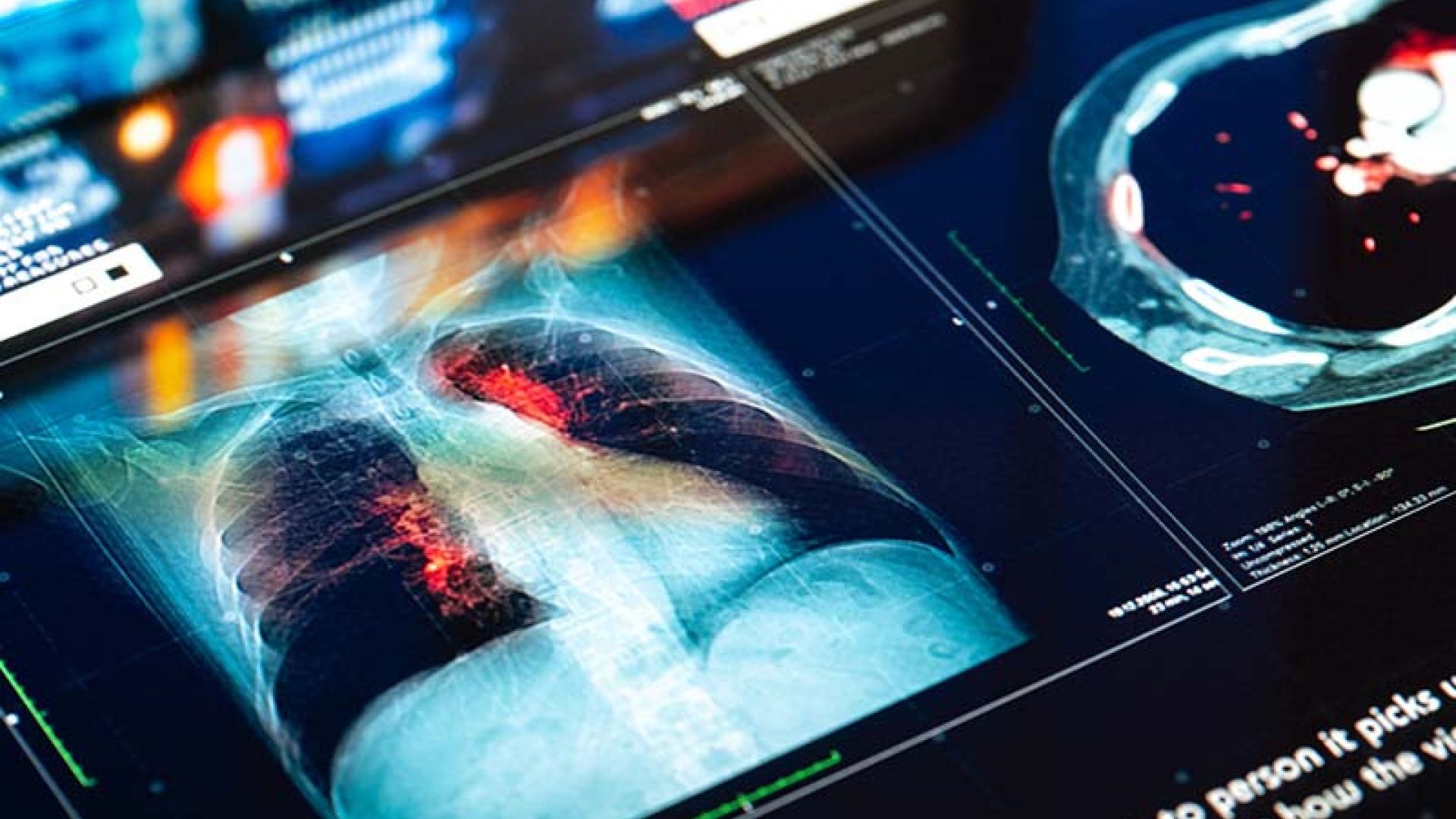 Digital medical imaging display showing chest scans with highlighted lung regions and data overlays, representing advanced radiology analysis, AI-assisted detection, and the need for accurate, reliable follow-up of diagnostic findings.